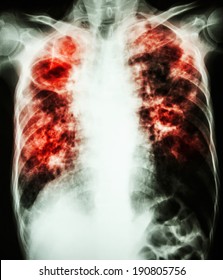 Film Chest X-ray Show Cavity At Right Lung,fibrosis & Interstitial & Patchy Infiltrate At Both Lung Due To Mycobacterium Tuberculosis Infection (Pulmonary Tuberculosis)