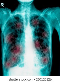 Film Chest X-ray Show Cavity At Right Lung,fibrosis & Interstitial & Patchy Infiltrate At Both Lung Due To Mycobacterium Tuberculosis Infection (Pulmonary Tuberculosis)