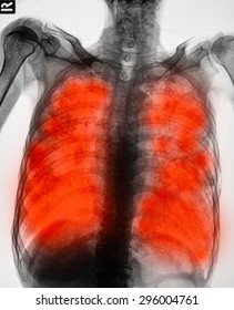 Film Chest X-ray Show Cavity At Right Lung,fibrosis & Interstitial & Patchy Infiltrate At Both Lung Due To Mycobacterium Tuberculosis Infection (Pulmonary Tuberculosis)