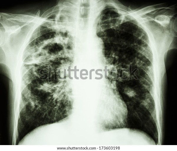 Film Chest Xray Show Cavity Right Stock Photo (Edit Now) 173603198