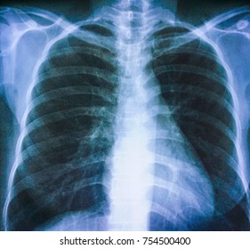 Film Chest Xray Show Normal Humans Stock Photo 774628960 | Shutterstock