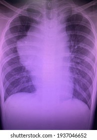 Film Chest X-ray Show Widening Mediastinum Impressions Of Anterior Mediasternal Tumor Primordial Germ Cell