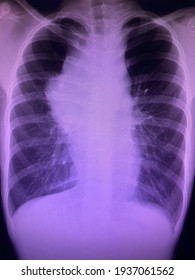 Film Chest X-ray Show Widening Mediastinum Impressions Of Anterior Mediasternal Tumor Primordial Germ Cell