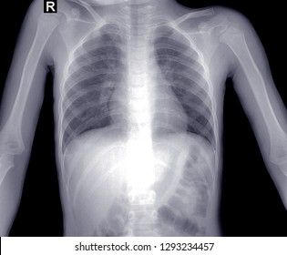 Film Chest Xray Of Young Child Suspected Pneumonia Or Lung Infection