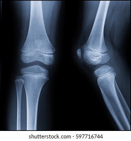 Film a child x-ray knee (AP,Lateral view) : show human's knee