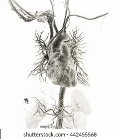 Film CT Scan Angiography Take Photo From Film With Negative Effect  