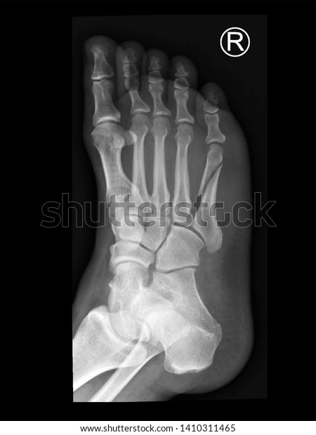 Film Foot Xray Radiograph Showing Toe Stock Photo 1410311465 | Shutterstock