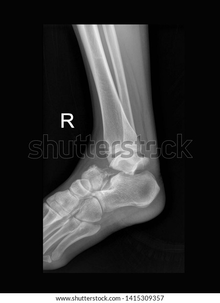 film foot X-ray radiograph showing ankle bone broken\
(talus bone of tarsus fracture) from sport injury. medical concept \
