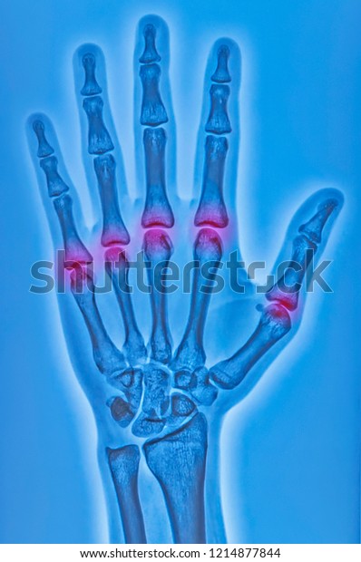 29 Metacarpophalangeal Joint Images, Stock Photos & Vectors | Shutterstock