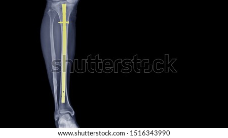 Film leg X ray radiograph show leg bone broken (tibia fracture) which treated by surgery and fixation with tibial nail prosthesis. Highlight on implant. medical technology concept