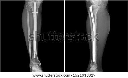 Film leg X-ray radiograph showing leg bone broken (tibia fracture) which treated by close reduction and internal fixation (CRIF) with tibial nail device. Medical equipment and technology concept