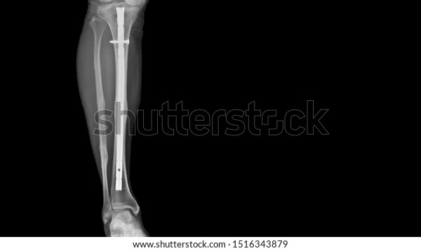 Film Leg Xray Radiograph Showing Leg Stock Photo Edit Now 1516343879
