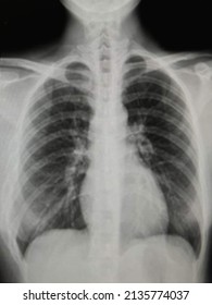 Film Lung Chest Xrays Female Chest Stock Photo 2135774037 | Shutterstock