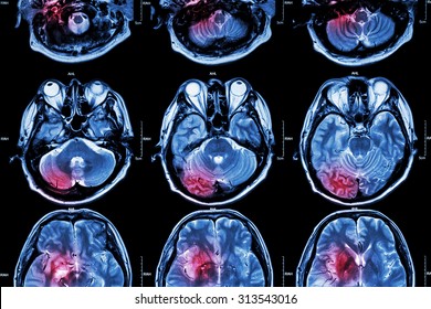 Film MRI ( Magnetic resonance imaging ) of brain ( stroke , brain tumor , cerebral infarction , intracerebral hemorrhage )  ( Medical , Health care , Science Background ) ( Cross section of brain )