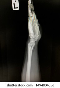 x ray wrist lateral view