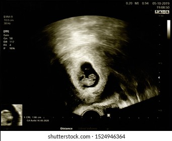 Film Ultrasound (US) whole abdomen of a 40 years old female patient scan of stomach in hospital. Ultrasound of baby in mother's 8 week or 2 months pregnant.