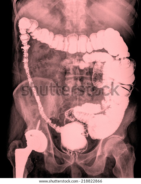 duodenal cap image clipart