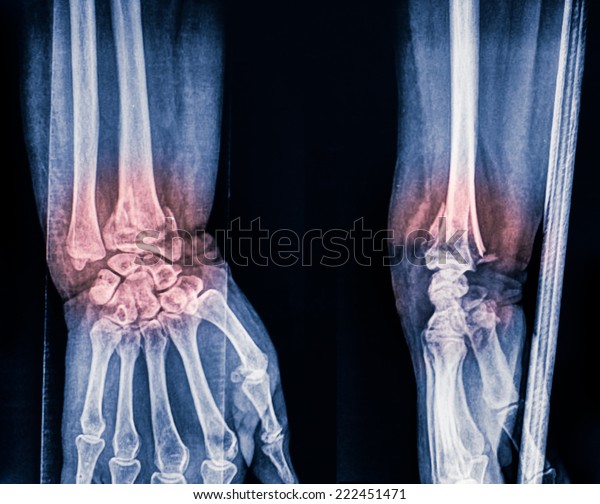 Film Wrist Show Fracture Distal Radius Stock Photo (Edit Now) 222451471