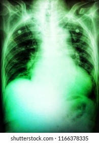 The Film X Ray Chest Bone Shows Thoracic Organ Of The Patient.