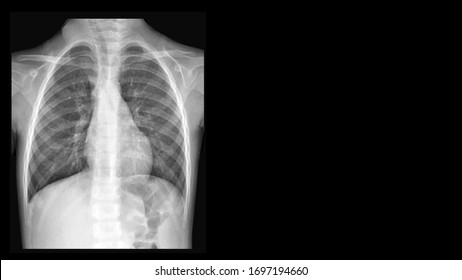 Film X ray chest radiograph (CXR) show perihilar infiltration and pleural thickening. This cause form viral pneumonia and bronchitis infection disease. Medical imaging investigation concept