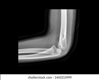 1,757 Humerus Fracture Images, Stock Photos & Vectors | Shutterstock