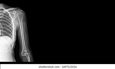 Film X ray elbow radiograph show elbow dislocation. Joint dislocation injury from trauma accident. The patient has elbow pain and limit joint motion. Medical imaging and diagnosis technology concept. - Shutterstock ID 1697113216