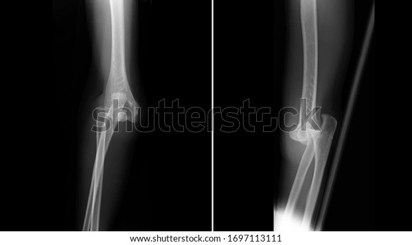 Film X ray elbow radiograph show elbow\
dislocation. Joint dislocation injury from physical assault. The\
patient has elbow pain and limit joint motion. Medical imaging and\
scan investigation\
concept.