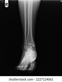 film x ray fracture of broken ankle - Shutterstock ID 2227124061
