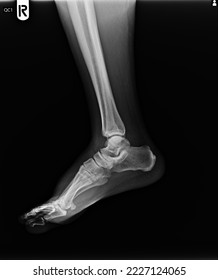 film x ray fracture of broken ankle - Shutterstock ID 2227124065