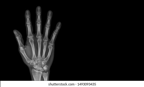 Film X ray hand radiograph show hand bone broken (fifth metacarpal fracture or Boxer's fracture) from sport injury. Patient has hand pain and deformity. Medical imaging and technology concept - Shutterstock ID 1493093435