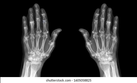 Film X ray hand radiography show degenerative osteoarthritis disease(OA disorder). Patient has finger joint arthritis,pain and stiffness problem. Medical diagnosis technology and examination concept.