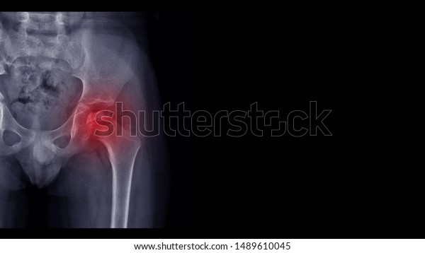 Film X ray hip radiograph show Legg Calve Perthes\
disease (LCPD). This is common hip disorder in children. Patient\
has hip pain, limp and walking problem. Highlight on painful area.\
Medical concept