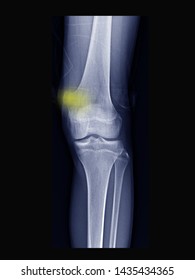 Film X Ray Knee Radiograph Show Osteochondroma Disease.
Osteochondrama Is The Most Common Benign Tumor Of Bone. Highlight On Bone Mass. Medical Neoplasm Concept