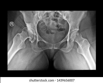 Film X Ray Pelvis Radiograph Show Developmental Dysplasia Of Right Hip (DDH) With Arthritis Change. The Left Hip Show Normal Bone And Joint. Medical Radiology Concept (R= Right Side)