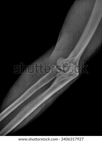 Film x ray or radiograph of a normal adult elbow. Lateral oblique view showing normal bone structure of humerus, radius and ulna