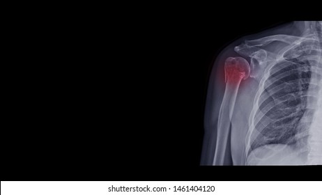 148 Humerus neck fracture Images, Stock Photos & Vectors | Shutterstock