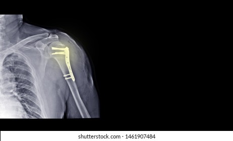 Film x ray shoulder radiograph show shoulder bone broken (neck of humerus fracture) treated by surgery with titanium plate implant. Highlight on metal instrument. Medical technology concept.