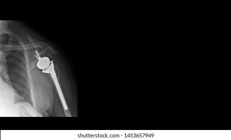 Film X Ray Shoulder Show Shoulder Joint Prosthesis. The Patient Has Rotator Cuff Syndrome Treated By Shoulder Replacement Surgery (reverse Shoulder Arthroplasty). Medical Technology Concept.