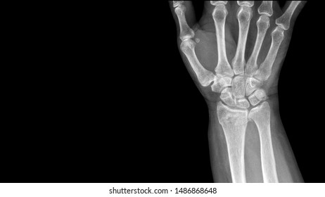 Film X Ray Wrist Radiograph Show Stock Photo 1608841024 | Shutterstock