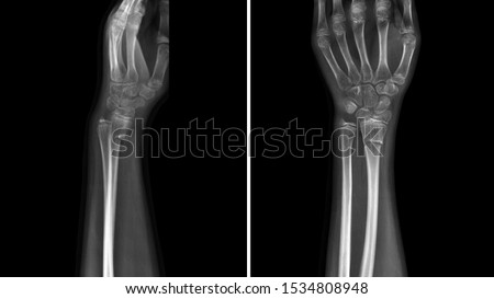 Film X ray wrist radiograph show wrist bone broken (torus or buckle fracture). The patient has wrist pain, swelling and deformity. Medical imaging and technology concept