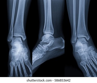 Ankle Fracture X Ray Film Images Stock Photos Vectors Shutterstock