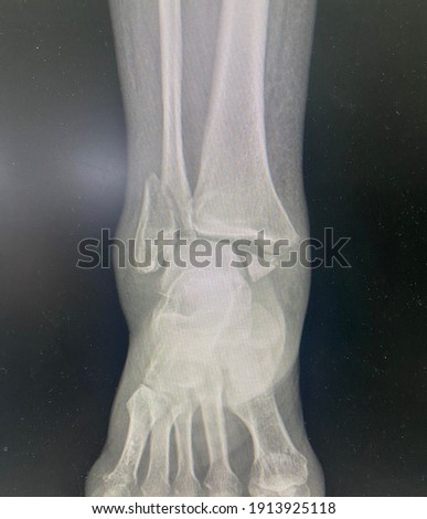 Film x-ray ankle series of patient who have right distal fibula fracture, Medical Technology and Science concept.