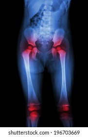 Film X-ray Body Of Child (abdomen,buttock,thigh,knee) And Arthritis At Both Hip , Both Knee (Gout,Rheumatoid)