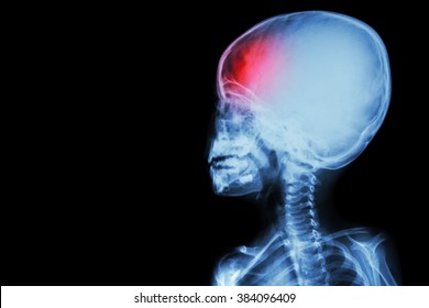 Film X-ray Body Of Child And Headache ( Brain Disease ) ( Isolated )