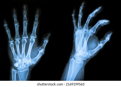 Film X-ray Both Hand AP