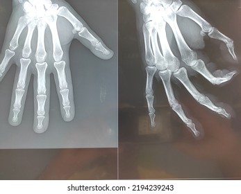 film x-ray both hand AP : show normal human's hands on black background (isolated)
 - Shutterstock ID 2194239243