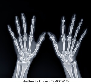 Film x-ray both hand AP view show  human's hands isolated  on black background . - Shutterstock ID 2259032075
