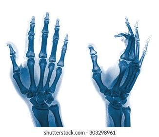 Xray Hands Front View Normal Human Stock Photo 290023874 | Shutterstock