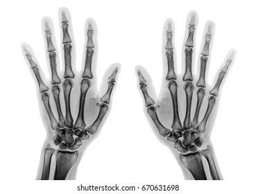 Film x-ray both hand AP show normal human hands on white background ( isolated ) - Shutterstock ID 670631698