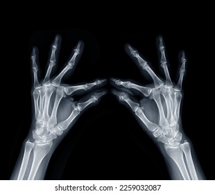 Film x-ray both hand oblique view show  human's hands isolated  on black background . - Shutterstock ID 2259032087